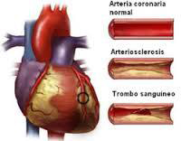 Arteriosclerosis y trombo